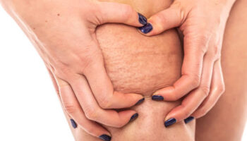 Cellulite on a woman's leg on a white background.