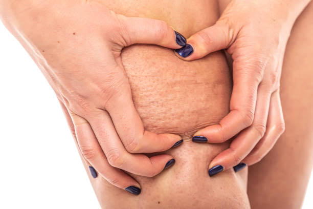 Cellulite on a woman's leg on a white background.