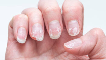 Flaky bitten and brittle nails without a manicure.