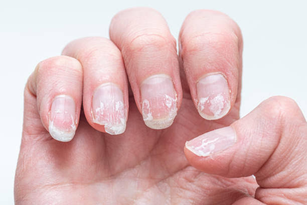 Flaky bitten and brittle nails without a manicure.